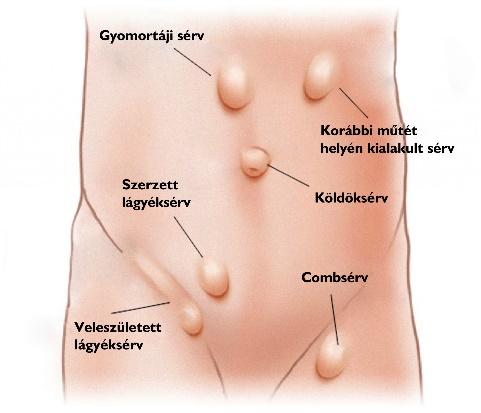 Sérvek típusai a testen