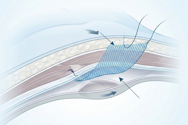 Surgical mesh placement during abdominal wall reconstruction