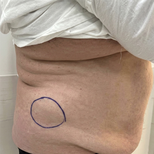 Oldalsó hasfali sérv klinikai kép – bejelölt sérvterület