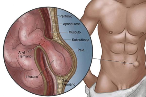 Sérvtípusok áttekintő ábra – a különböző hasfali sérvek lokalizációja