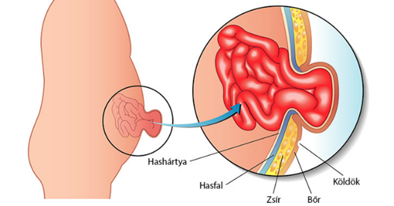 Köldöksérv anatómiai illusztráció